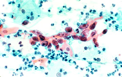 Cervical cancer smear